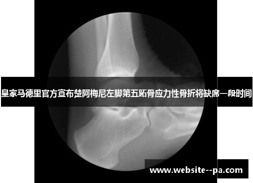 皇家马德里官方宣布楚阿梅尼左脚第五跖骨应力性骨折将缺席一段时间 皇家马德里官方宣布楚阿梅尼左脚第五跖骨应力性骨折将缺席一段时间